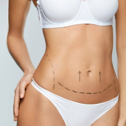 Beautiful-Woman-Body-With-Surgical-Lines.-Surgery-Operation-850x1024